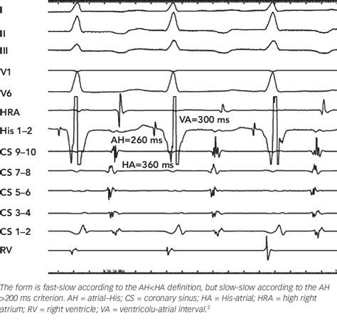 Figure 2 From Classification Electrophysiological Features And Therapy