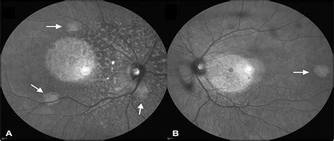 Bilateral Diffuse Uveal Melanocytic Proliferation Associated