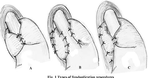 Pdf A Modified Nissen Toupet Procedure For The Treatment Of Gastro