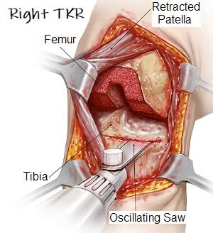 Kneecap Surgery