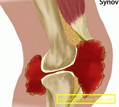 Sinovitis de la articulación de la rodilla