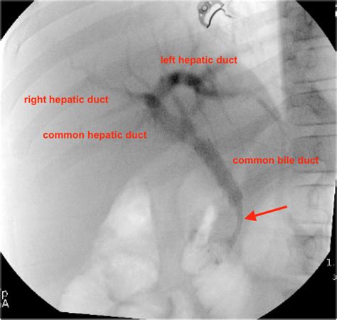 Endoscopic Retrograde Cholangiopancreatography Ercp Ercp Shows Download Scientific Diagram