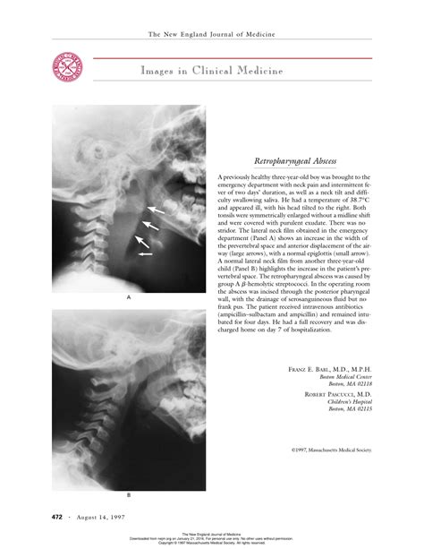 Images in clinical medicine. Retropharyngeal abscess (PDF Download Available)