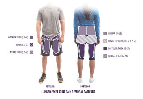 Lumbar Facet Joint Pain Referral Patterns