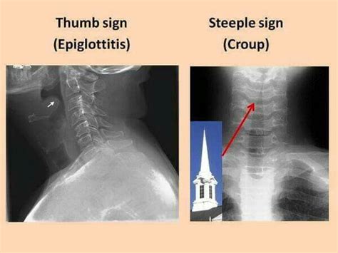 Thumb And Steeple Sign Radiology Imaging Basic Anatomy And Physiology Medical Imaging