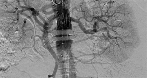 EVAR Shown to IMPROVE Outcomes Over Surgery for Ruptured AAA Patients ...