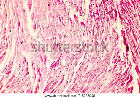 Heart Hypertrophy Photomicrograph Showing Hypertrophic Myocardium Stock