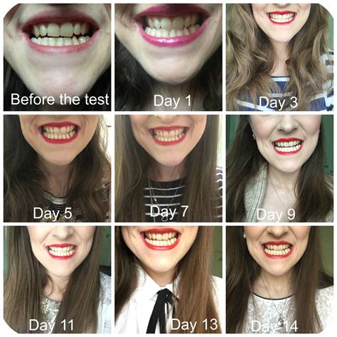 Get Whiter Teeth In 2 Weeks With Colgate Teeth Whitening Pen