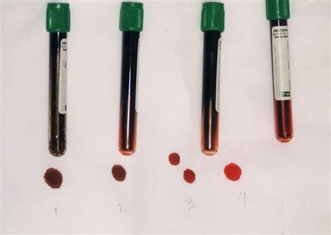 Methemoglobinemia