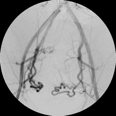 Uterine Artery Embolisation Radiology Reference Article Radiopaedia Org