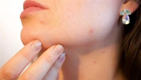 Pimples On Chin Meaning Myth And Its Location Guide For Your Skin Problem