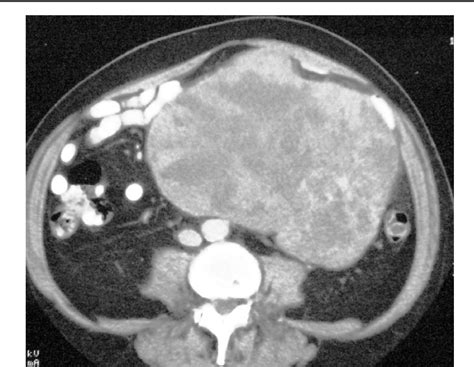 Figure From The Radiology Of Gastrointestinal Stromal Tumours Gist