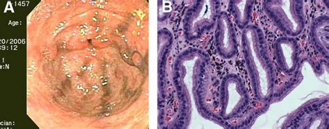 Isolated Melanosis Of The Gastric Antrum An Unusual Endoscopic Finding Clinical