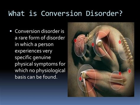 Ppt Conversion Disorder Powerpoint Presentation Free Download Id