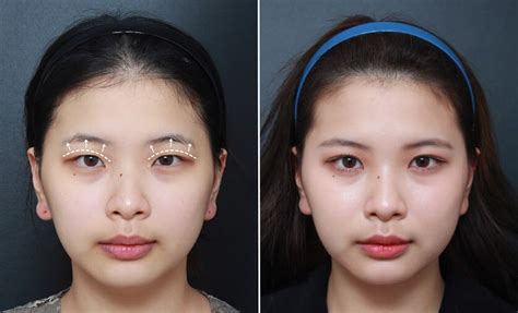 Double Eyelid Surgery Or Asian Blepharoplasty In Seoul Korea