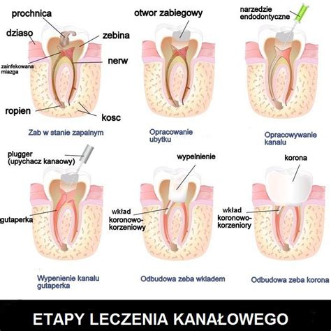 Leczenie Kana Owe Kalmed Stomatologia Raszyn Ortodonta Chirurg