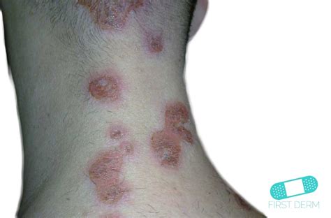 Online Dermatology - Impetigo (School Sores)