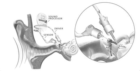 —Esteem by Envoy Middle Ear Implant (Courtesy of Envoy Medical ...