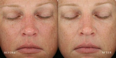 Microdermabrasion At Laser Skin Institute Chatam New Jersey