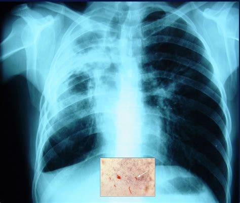 Radiografia Tuberculosis