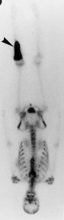 A B A 24 Year Old Female Patient With Ewings Sarcoma Of The Proximal