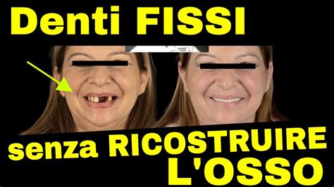 Denti Fissi Senza Ricostruzione Ossea YouTube