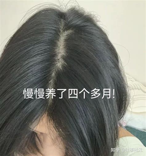 女性脂溢性脱发分享 知乎