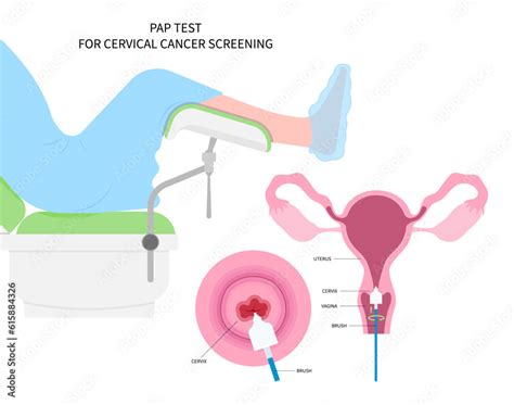 Diagnostic Procedure For Cervix Cancer Of Women Female And Vulvar Warts