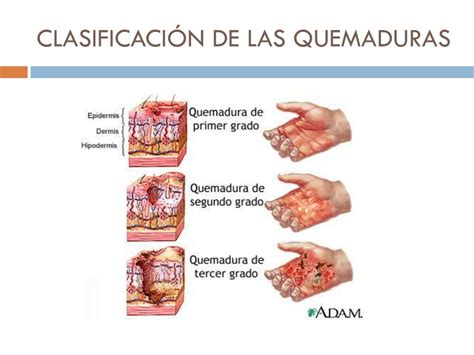 Quemaduras Y Tipos