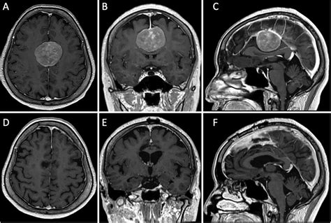 Successful Resection Of Bilateral Parafalcine Meningioma With