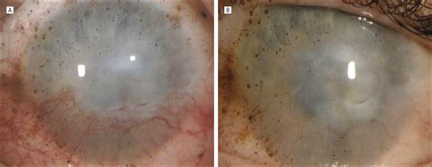 Topical Bevacizumab Therapy for Corneal Neovascularization | Cornea ...