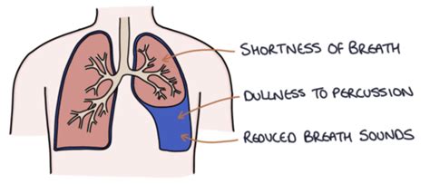 Pleural Effusion Flashcards Quizlet