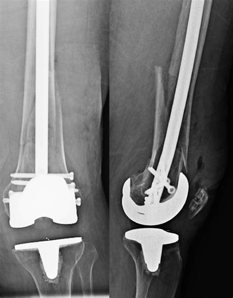 Outcomes Of Periprosthetic Distal Femur Fractures Following Total Knee Arthroplasty