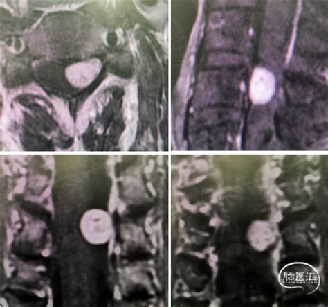 中山大学附属肿瘤医院张继教授：单椎板入路切c4椎管内神经鞘瘤 脑医汇 神外资讯 神介资讯