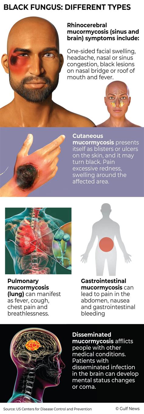 Why Black Fungus Aggravates COVID 19 Crisis In India Special Reports