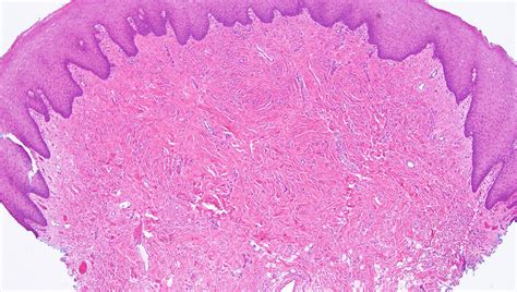 Oral Giant Cell Fibroma