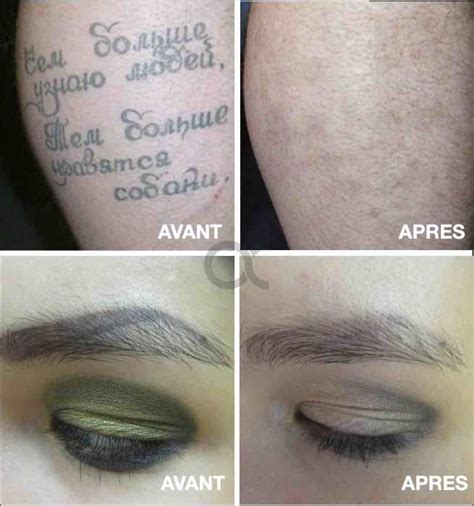 Centre De M Decine Esth Tique Alfa Laser Colmar Injections Et Lasers