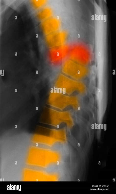 Thoracic Spine Fracture