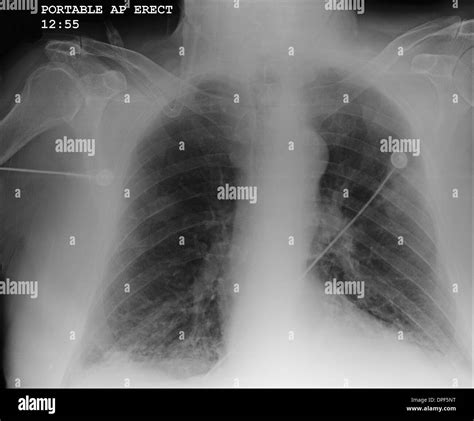 Radiograf A De T Rax Que Muestra La Epoc Fotograf A De Stock Alamy