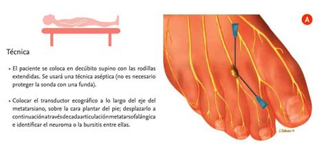 Neuroma de Morton Causas síntomas y tratamientos efectivos Neurat