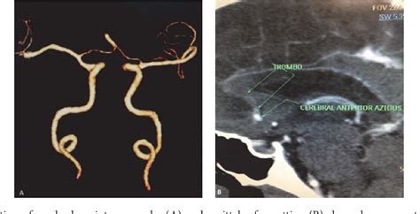 Figure From Thrombosis Of The Azygos Anterior Cerebral Artery