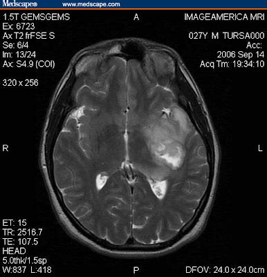 USA Cancer Information: Anaplastic Oligodendroglioma Picture | USA Cancer Information