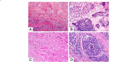 Usual Basaloid Squamous Cell Carcinoma A Superiorly Note Areas Of