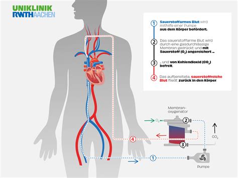 Überleben ECMO Therapie als letzte Hoffnung apropos gesund