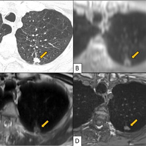 Ct A Ute B Haste C Vibe D Left Upper Lobe Spiculated Solid Download Scientific