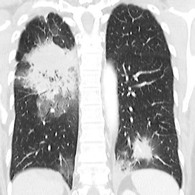 Pulmonary Metastases | Radiology Key