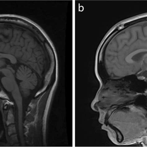 The Mri Of Our Patient A Age Years Normal On T Weighted Sagittal