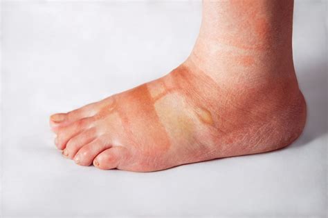 Foot Blisters Treatment By Steady Gait Foot Clinic In Scarborough