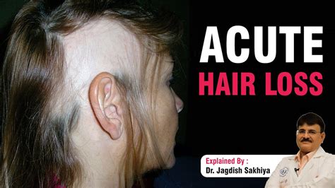 What Is Acute Hair Loss Causes Treatments By Dr Jagdish Sakhiya