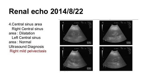 Case Report Nephrotic Syndrome